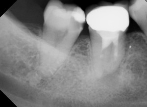 C-shaped with a lateral apical foramen 1